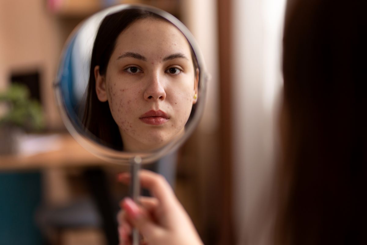kozní problémy jako rosacea, ekzem, akne umí snížit sebevědomí